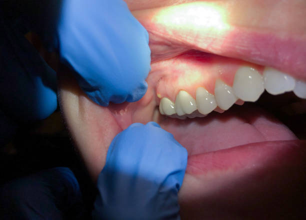 Best Chipped Tooth Repair Near Me  in Malakoff, TX